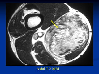 Axial T-2 MRI
 