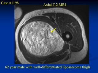 Case #1198                Axial T-2 MRI




  62 year male with well-differentiated liposarcoma thigh
 