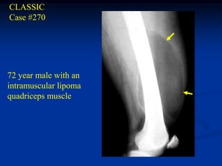 CLASSIC
Case #270




72 year male with an
intramuscular lipoma
quadriceps muscle
 