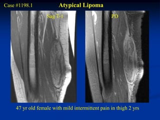 Case #1198.1            Atypical Lipoma
                  Sag T-1                        PD




    47 yr old female with mild intermittent pain in thigh 2 yrs
 