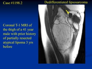 Case #1198.2              Dedifferentiated lipsosarcoma




Coronal T-1 MRI of
the thigh of a 41 year
male with prior history
of partially resected
atypical lipoma 3 yrs
before
 