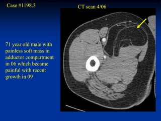Case #1198.3            CT scan 4/06




71 year old male with
painless soft mass in
adductor compartment
in 06 which became
painful with recent
growth in 09
 