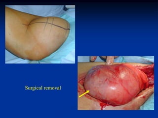 Surgical removal
 