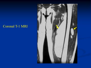 Coronal T-1 MRI
 