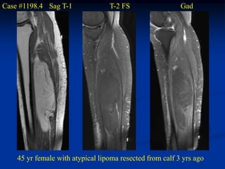 Case #1198.4 Sag T-1              T-2 FS                  Gad




    45 yr female with atypical lipoma resected from calf 3 yrs ago
 