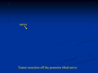 nerve




Tumor resection off the posterior tibial nerve
 