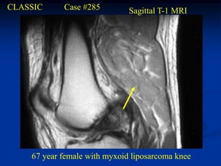 CLASSIC     Case #285         Sagittal T-1 MRI




    67 year female with myxoid liposarcoma knee
 