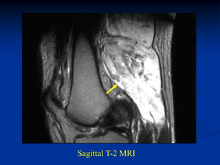 Sagittal T-2 MRI
 