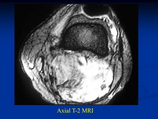 Axial T-2 MRI
 