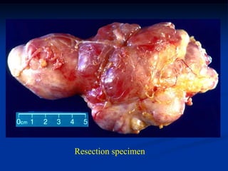 Resection specimen
 