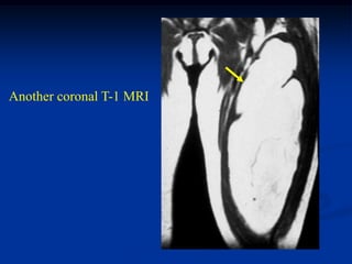 Another coronal T-1 MRI
 