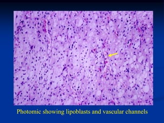 Photomic showing lipoblasts and vascular channels
 