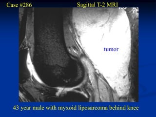 Case #286                 Sagittal T-2 MRI




                                    tumor




  43 year male with myxoid liposarcoma behind knee
 