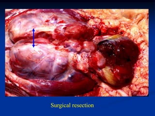 Surgical resection
 