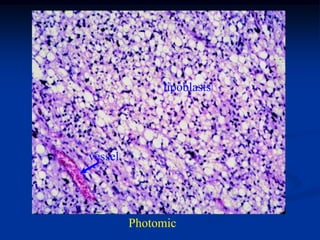 lipoblasts




vessel




         Photomic
 