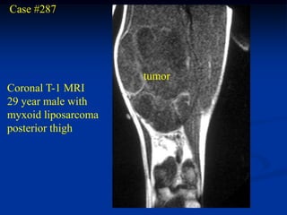 Case #287




                     tumor
Coronal T-1 MRI
29 year male with
myxoid liposarcoma
posterior thigh
 
