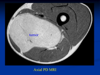 tumor




  Axial PD MRI
 