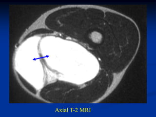 Axial T-2 MRI
 