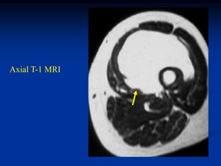 Axial T-1 MRI
 