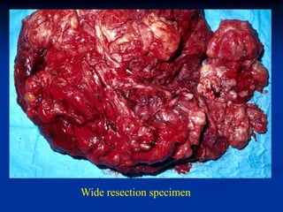Wide resection specimen
 