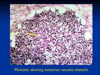 Photomic showing numerous vascular channels
 