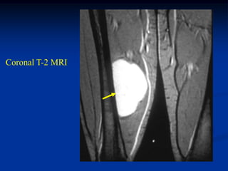 Coronal T-2 MRI
 