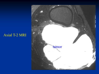Axial T-2 MRI


                tumor
 