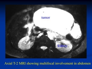 tumor




                                 kidney



Axial T-2 MRI showing multifocal involvement in abdomen
 