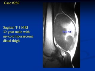 Case #289




Sagittal T-1 MRI
32 year male with    tumor
myxoid liposarcoma
distal thigh
 