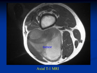 tumor




Axial T-1 MRI
 