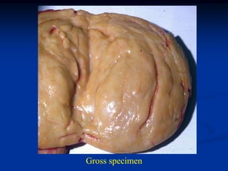 Gross specimen
 