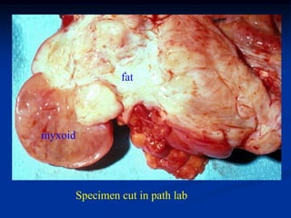 fat




myxoid




     Specimen cut in path lab
 