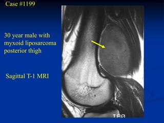 Case #1199



30 year male with
myxoid liposarcoma
posterior thigh


Sagittal T-1 MRI
 