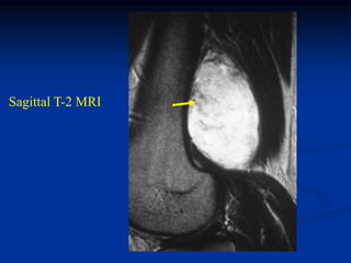 Sagittal T-2 MRI
 