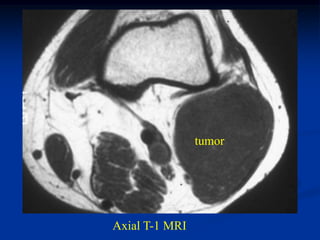 tumor




Axial T-1 MRI
 
