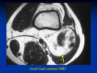 Axial Gad contrast MRI
 