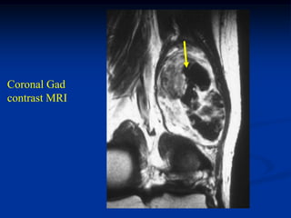Coronal Gad
contrast MRI
 