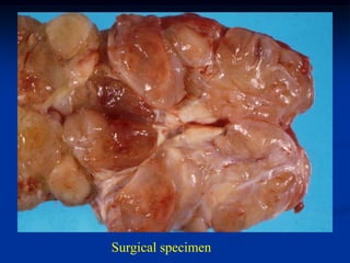 Surgical specimen
 