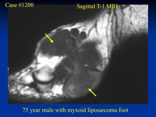 Case #1200                 Sagittal T-1 MRI




      75 year male with myxoid liposarcoma foot
 
