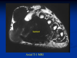 tumor




Axial T-1 MRI
 