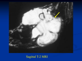 Sagittal T-2 MRI
 