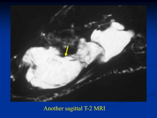Another sagittal T-2 MRI
 