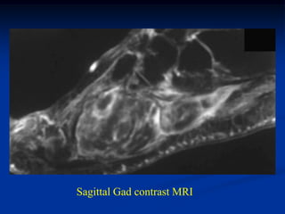 Sagittal Gad contrast MRI
 