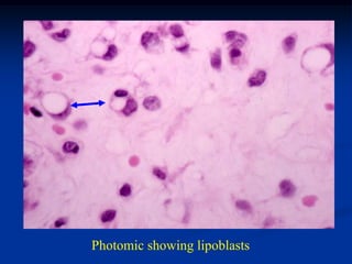 Photomic showing lipoblasts
 