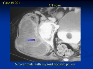 Case #1201
                            CT scan




             tumor




      69 year male with myxoid liposarc pelvis
 