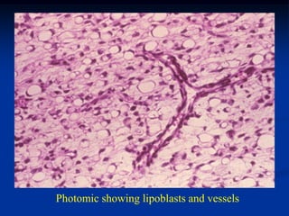 Photomic showing lipoblasts and vessels
 