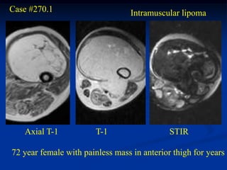 Case #270.1                       Intramuscular lipoma




   Axial T-1            T-1                  STIR

72 year female with painless mass in anterior thigh for years
 