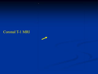 Coronal T-1 MRI
 