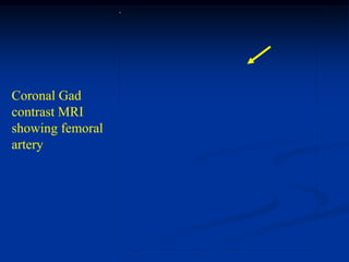 Coronal Gad
contrast MRI
showing femoral
artery
 