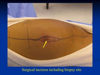Surgical incision including biopsy site
 